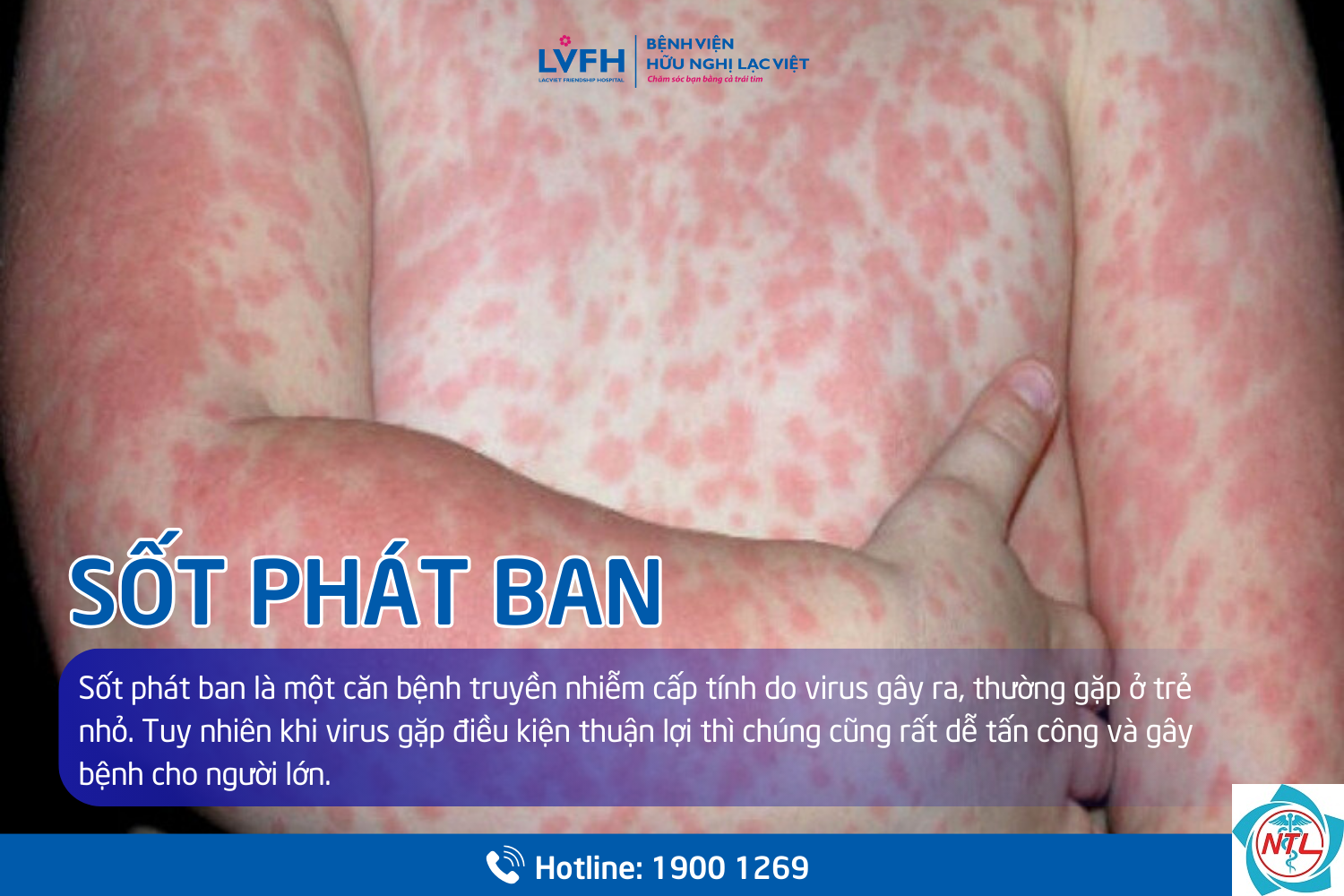 phát ban ở trẻ em - Image 4