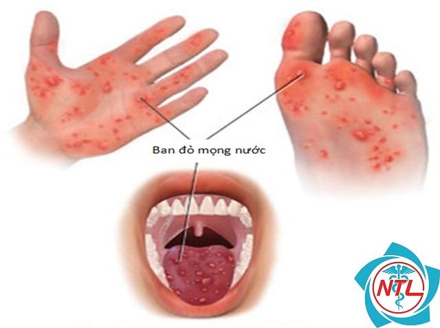 phát ban tay chân miệng - Image 4