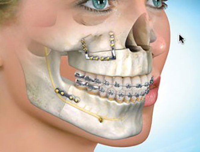 phẫu thuật chỉnh xương hàm - Image 2