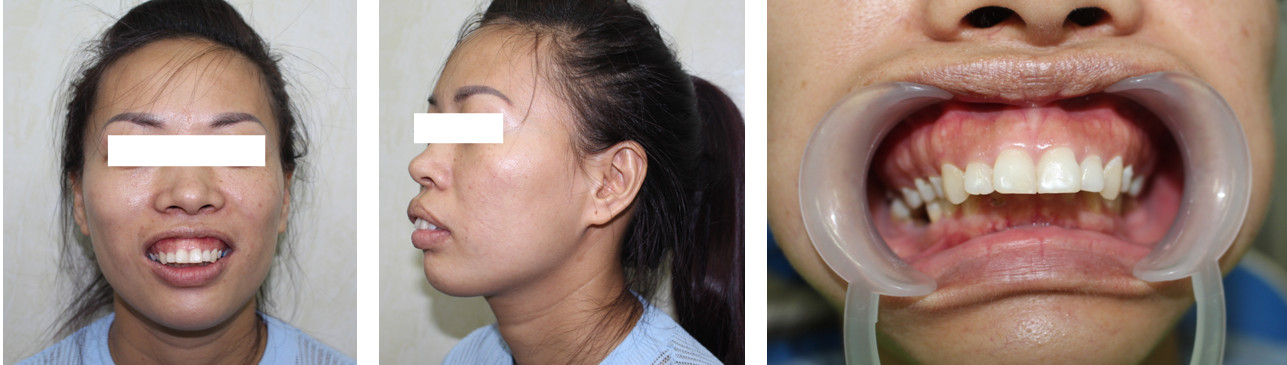 phẫu thuật chỉnh xương hàm - Image 3