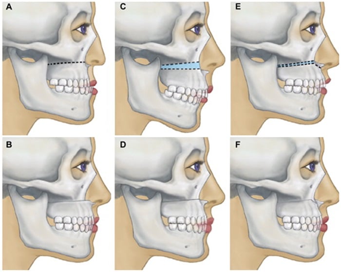 phẫu thuật chỉnh xương hàm