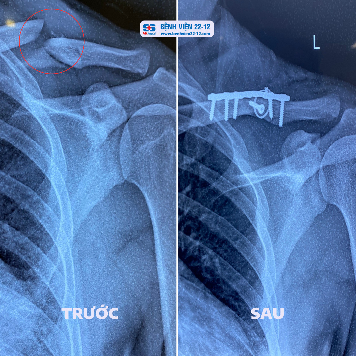 phẫu thuật kết hợp xương đòn - Image 3