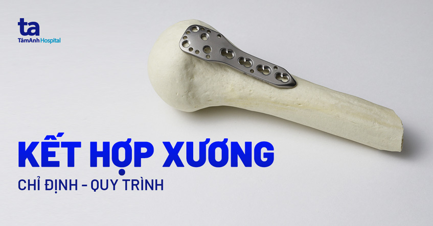 phẫu thuật xương - Image 2