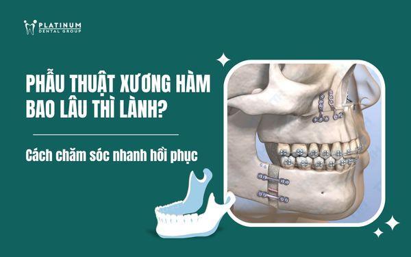 phẫu thuật xương hàm - Image 5
