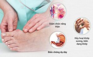 phòng ngừa cơn gout