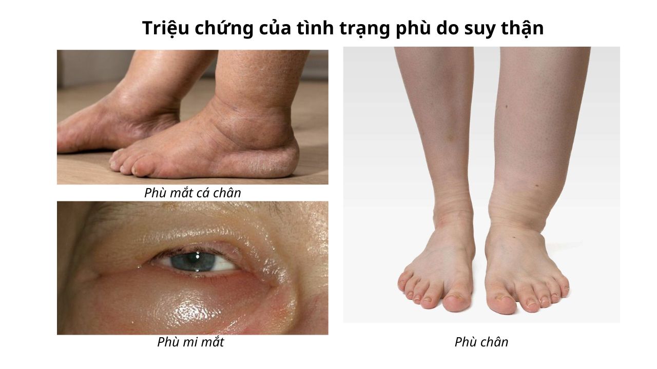 phù chân do bệnh thận - Image 2