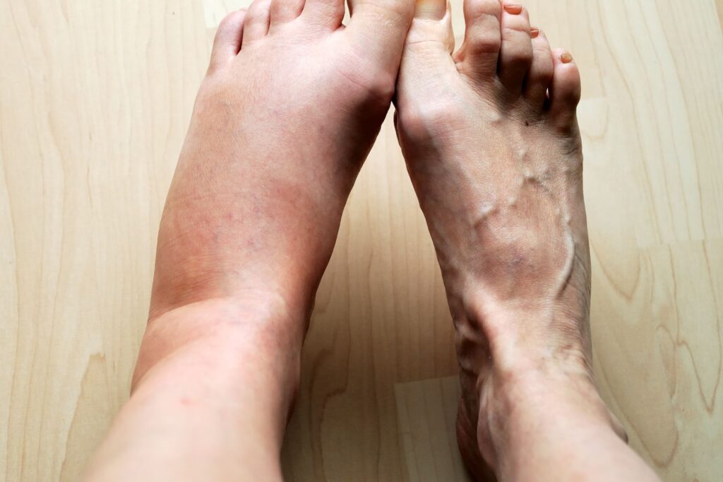 phù chân kèm khó thở