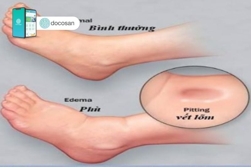 phù chân là dấu hiệu bệnh gì - Image 3