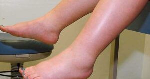 phù chân ở người cao tuổi