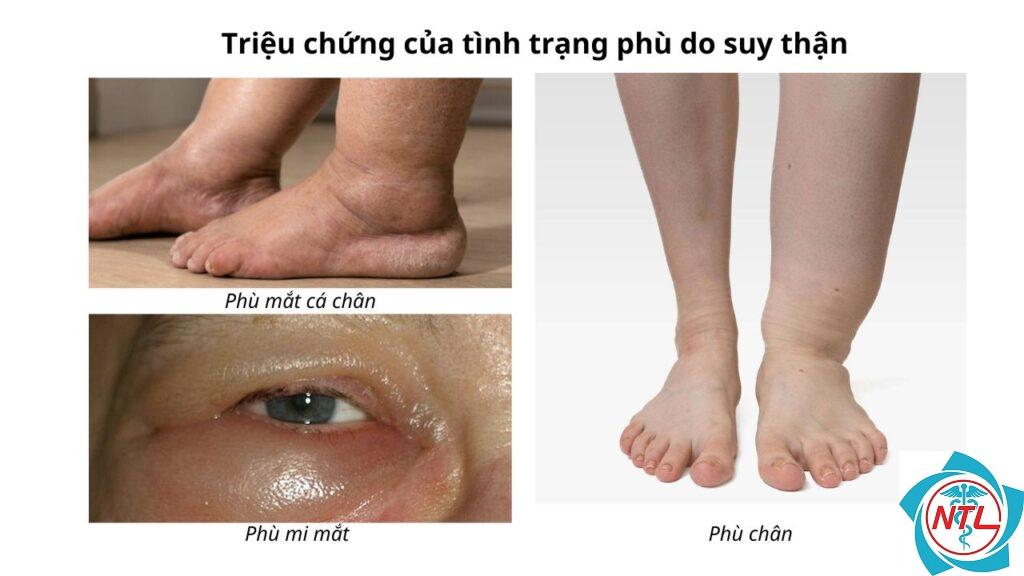 phù do bệnh thận