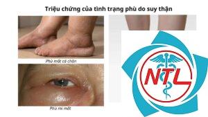 phù do bệnh thận