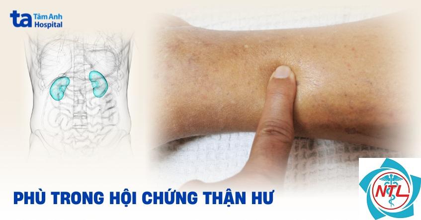 phù do bệnh thận - Image 4