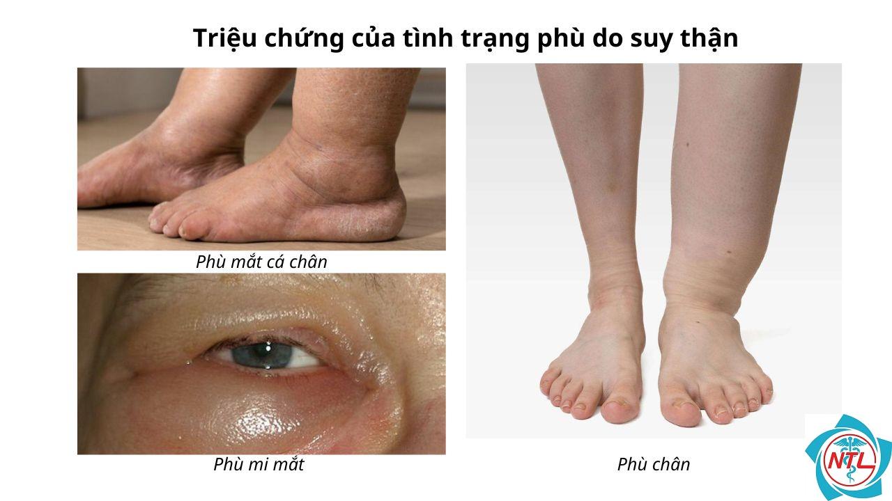 phù do bệnh thận - Image 1