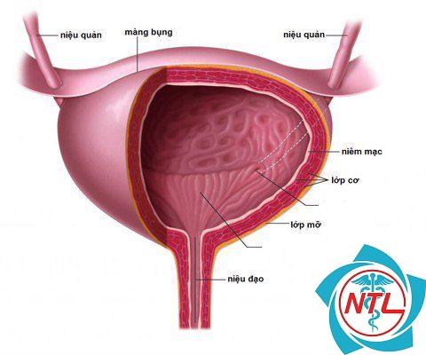 polyp bàng quang - Image 2