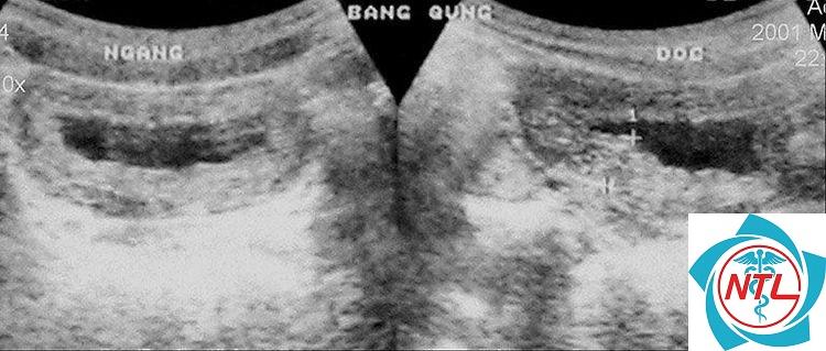 polyp bàng quang - Image 3