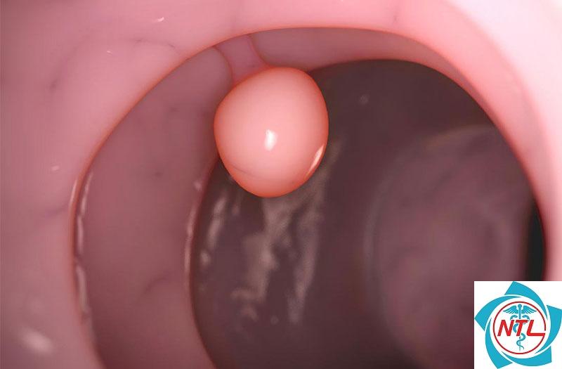 polyp bàng quang - Image 4