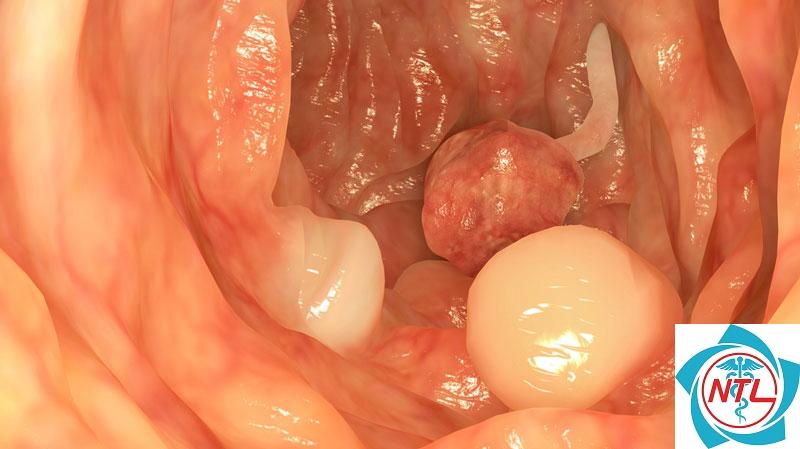 polyp bàng quang - Image 5