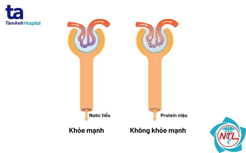 protein niệu - Image 5