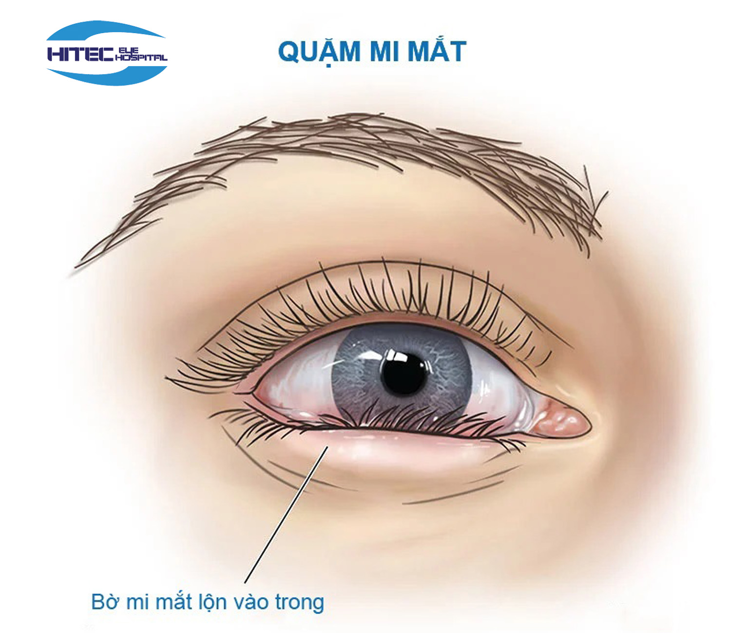 quặm mi - Image 1