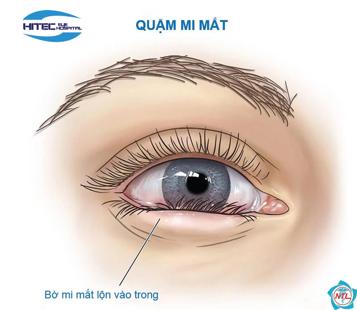 quặm mi là gì - Image 1