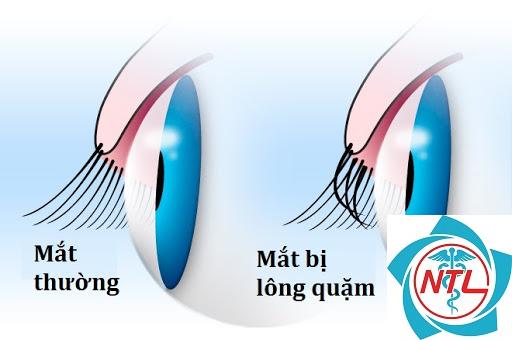quặm mi là gì - Image 3