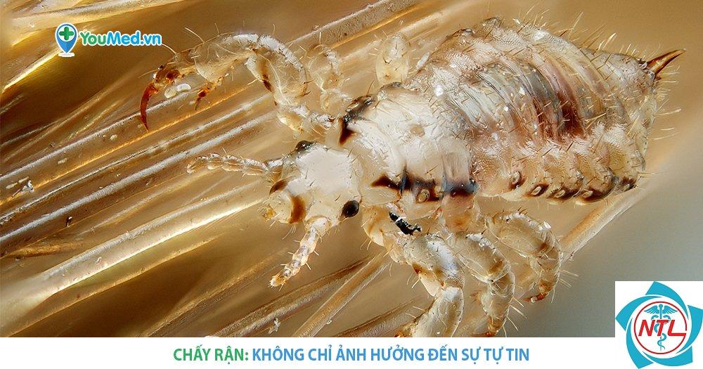 rận đầu - Image 2