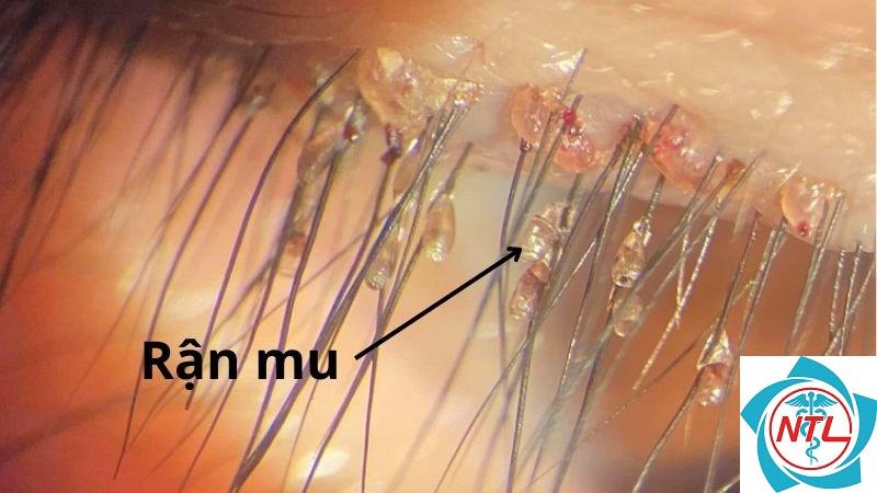 rận mu ở người lớn - Image 2