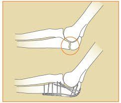rạn xương khuỷu tay bao lâu thì lành - Image 3