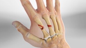 rạn xương tay bao lâu thì khỏi
