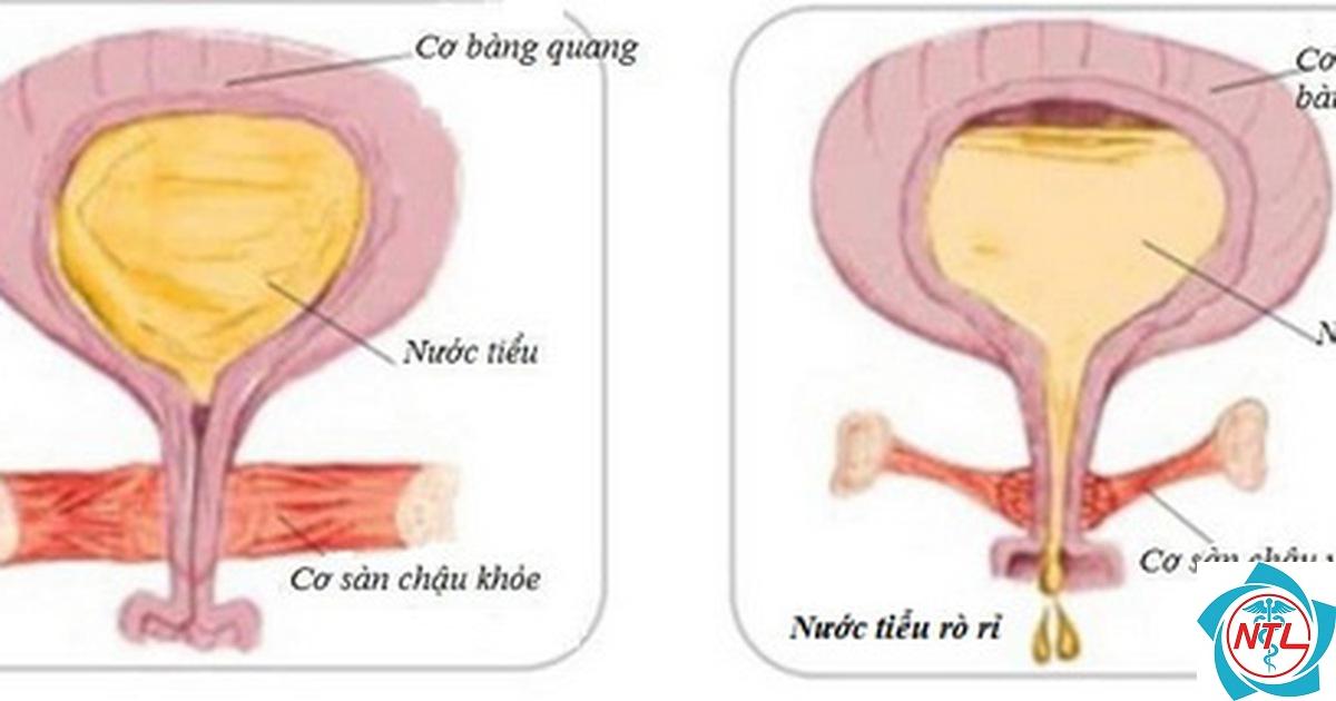 rối loạn bài xuất nước tiểu - Image 4