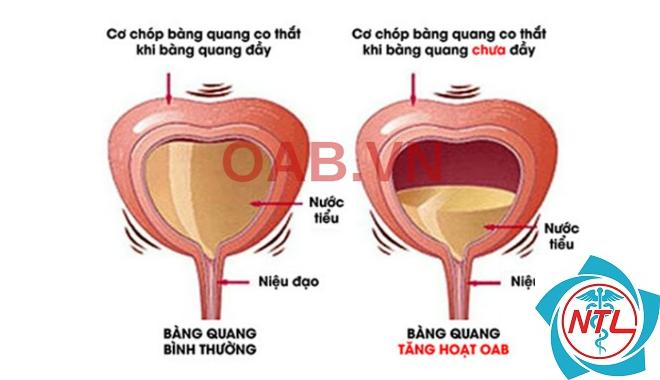 rối loạn chức năng bàng quang - Image 4