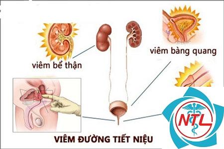 rối loạn chức năng đường tiết niệu - Image 2