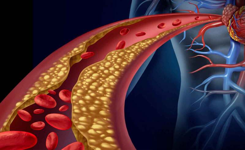 rối loạn lipid máu - Image 3