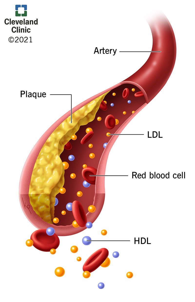 rối loạn lipid máu - Image 5
