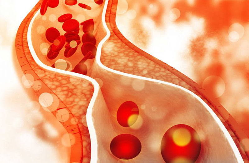 rối loạn lipid máu ở người tiểu đường - Image 2