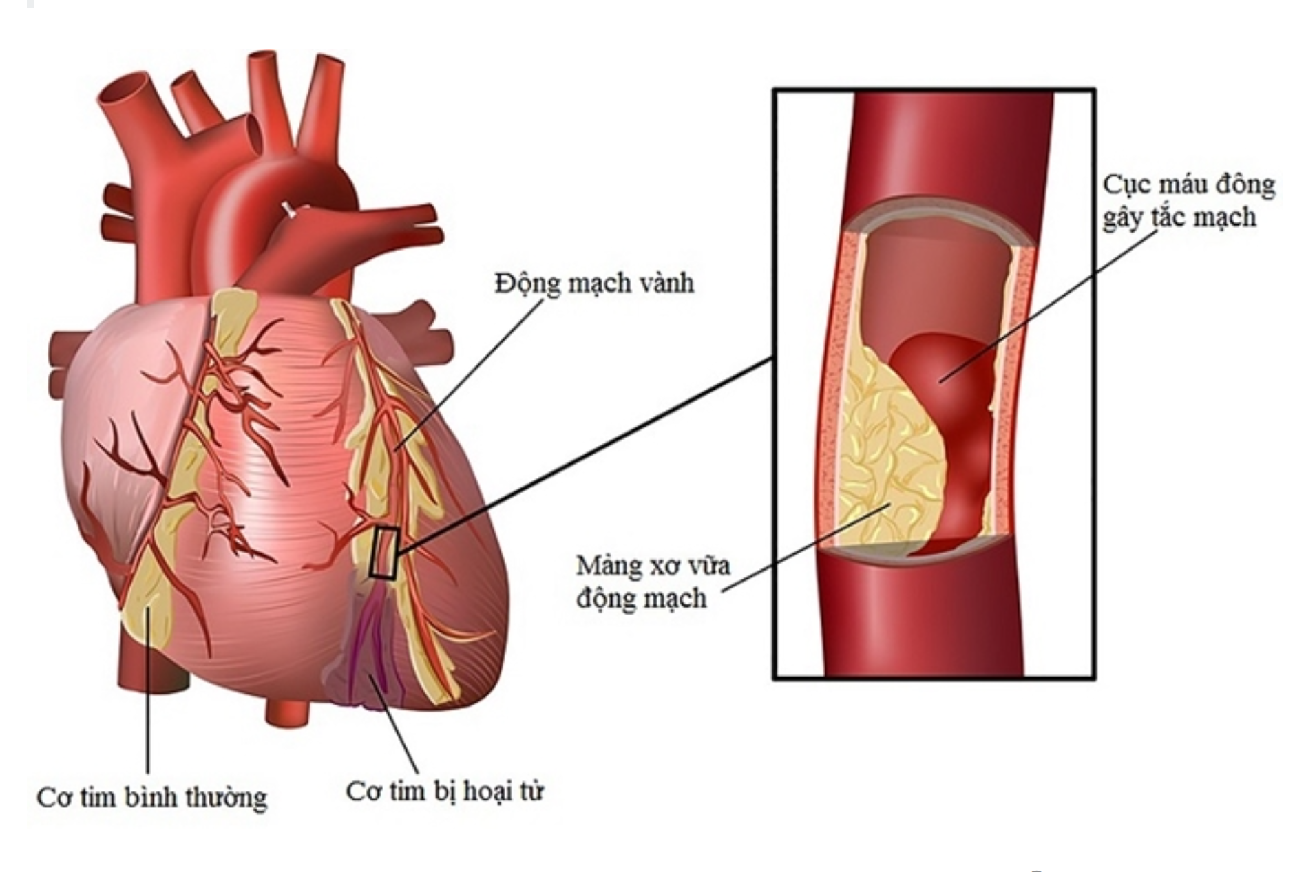 rối loạn lipid máu và bệnh tim - Image 3