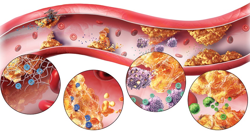 rối loạn lipid máu - Image 1