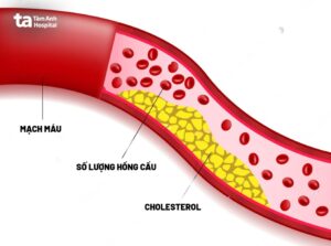 rối loạn mỡ máu
