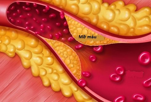 rối loạn mỡ máu - Image 5