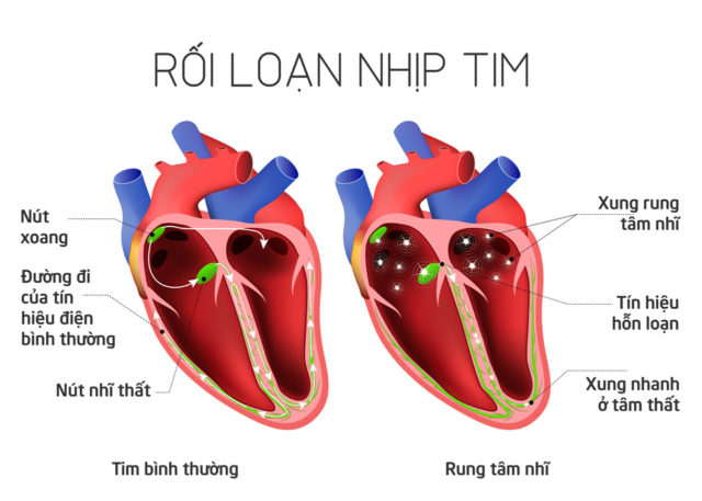 rối loạn nhịp tim - Image 2