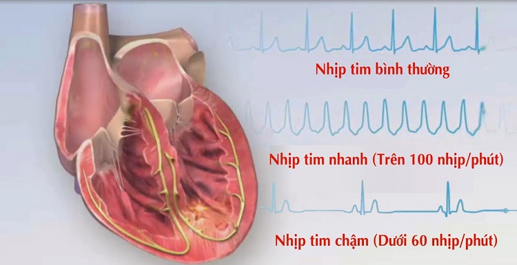 rối loạn nhịp tim - Image 5