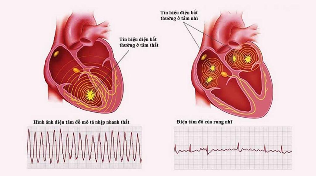 rối loạn nhịp tim kèm ngất