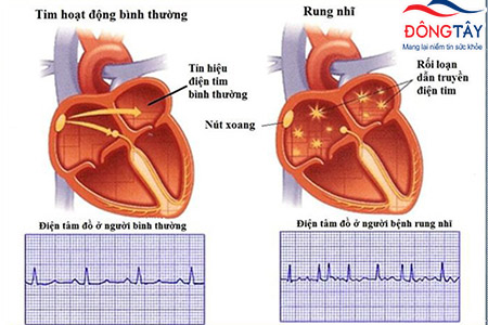 rối loạn nhịp tim là gì - Image 3