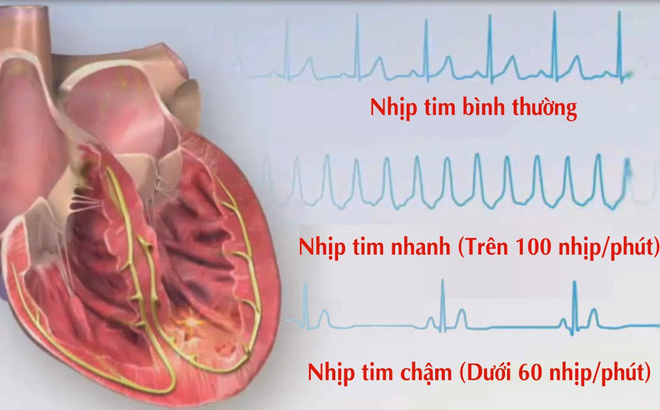 rối loạn nhịp tim ở người cao tuổi - Image 5