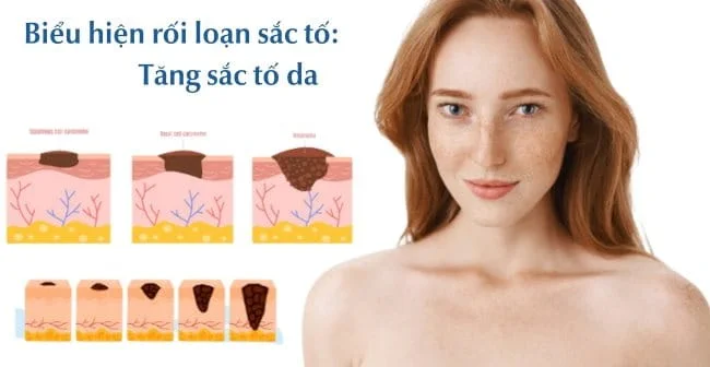 rối loạn sắc tố da - Image 5