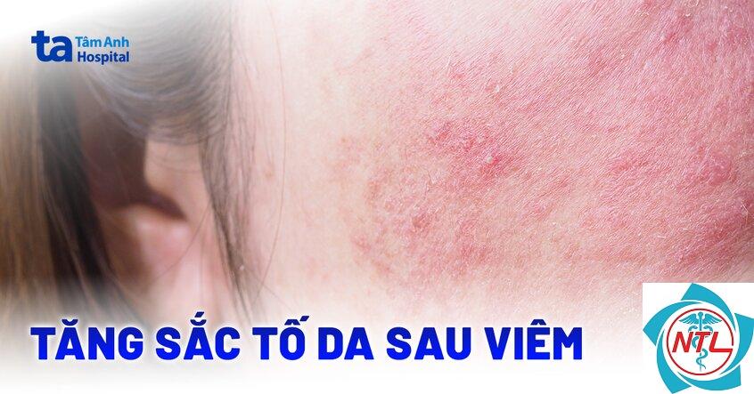 rối loạn sắc tố sau viêm - Image 2