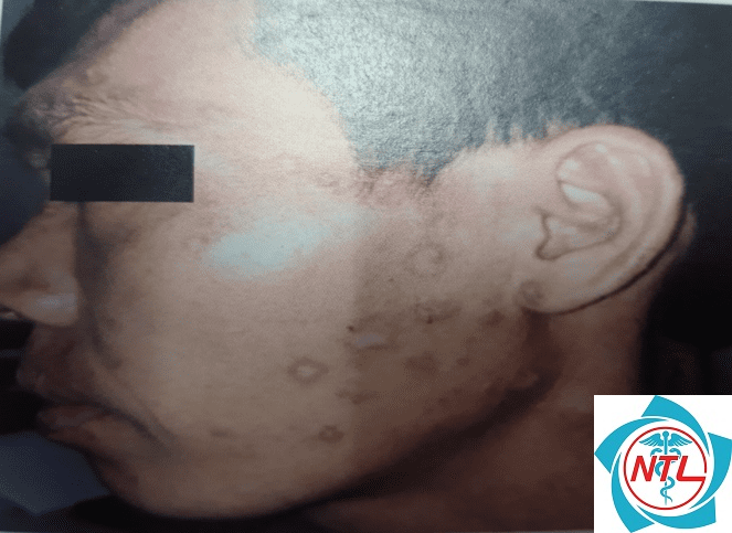 rối loạn sắc tố sau viêm - Image 3