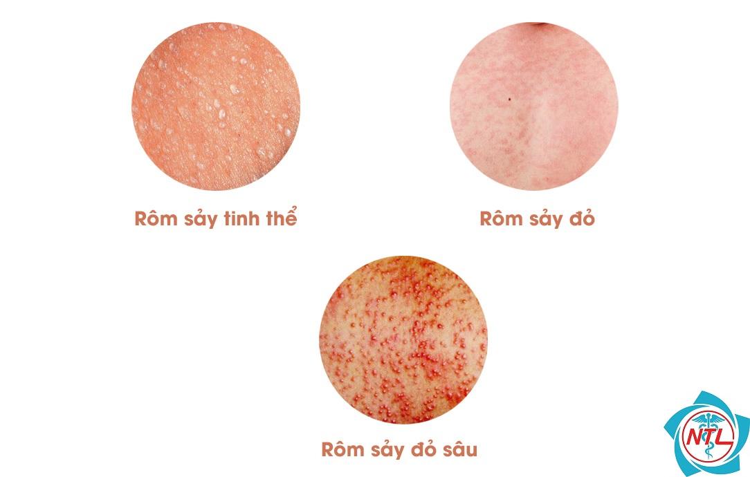 rôm sảy - Image 2