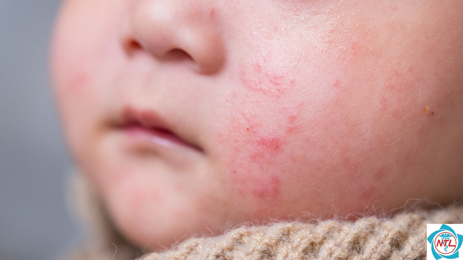 rôm sảy - Image 4