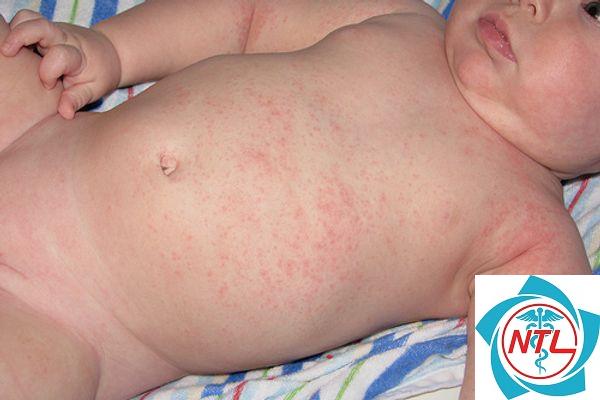 rôm sảy mùa hè - Image 5